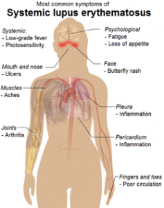 Lasting Effects of Lupus